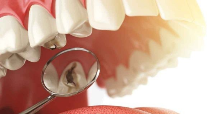إزالة تسوس الاسنان| 11 طريقة للتخلص من التسوس نهائيا